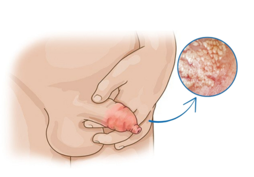 Sưng dương vật là bệnh gì? Nguyên nhân, dấu hiệu và cách điều trị